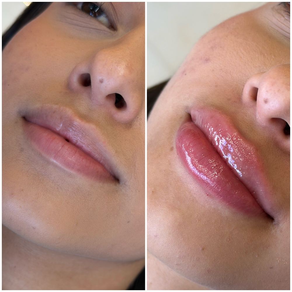 Preenchimento labial, antes e depois