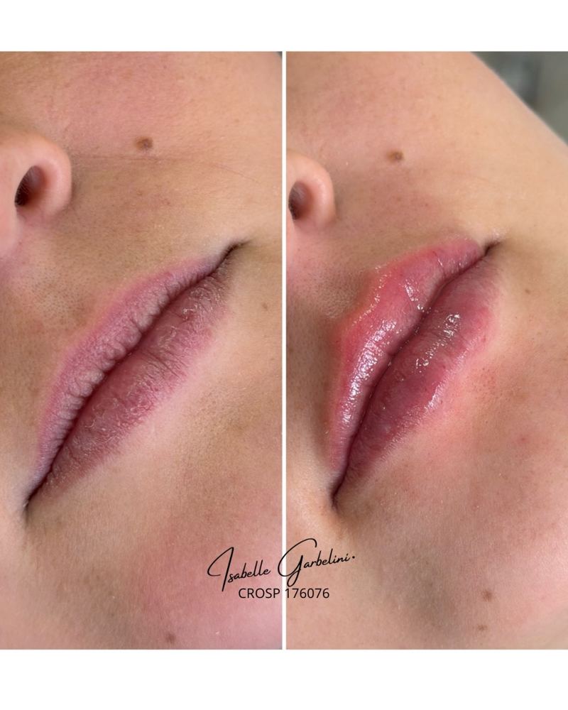 Preenchimento labial, antes e depois