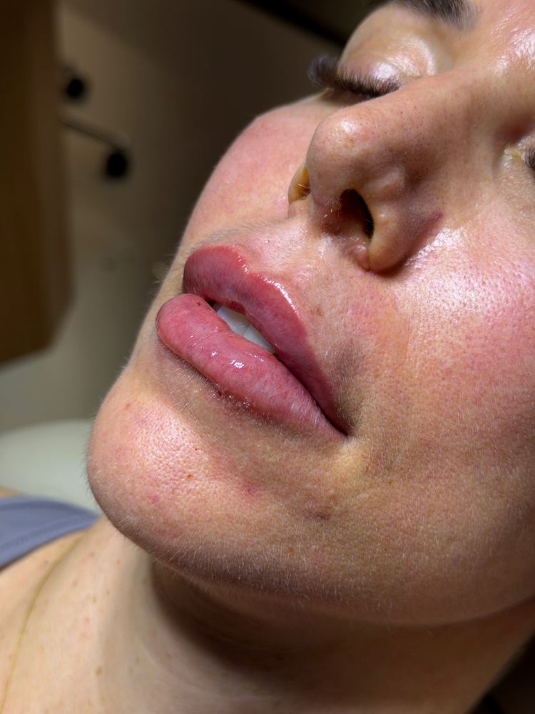 Preenchimento labial, resultado